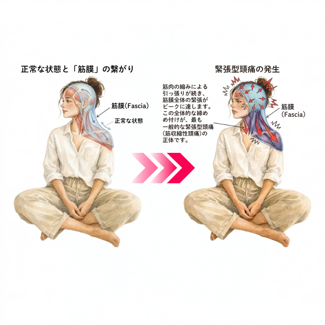 片頭痛1.png