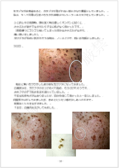 その頑固なシミ そばかすとお別れしたいと思いませんか たった５日でシミそばかすがポロポロ 家で簡単安く Mofunyanko Coconalaブログ