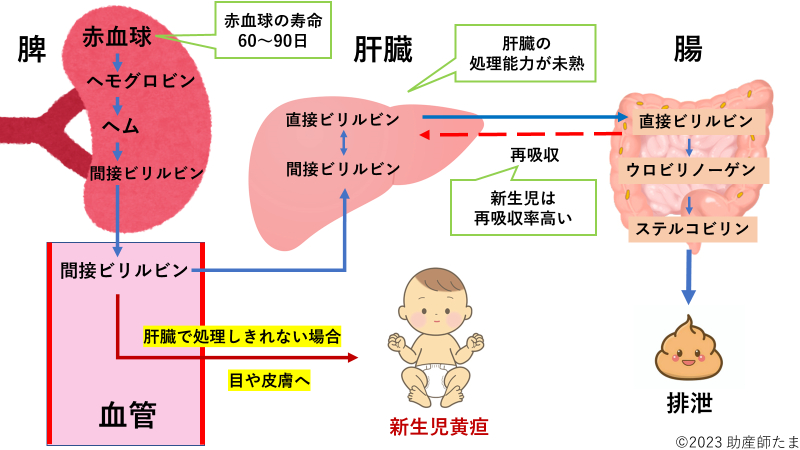 新生児黄疸図解.png