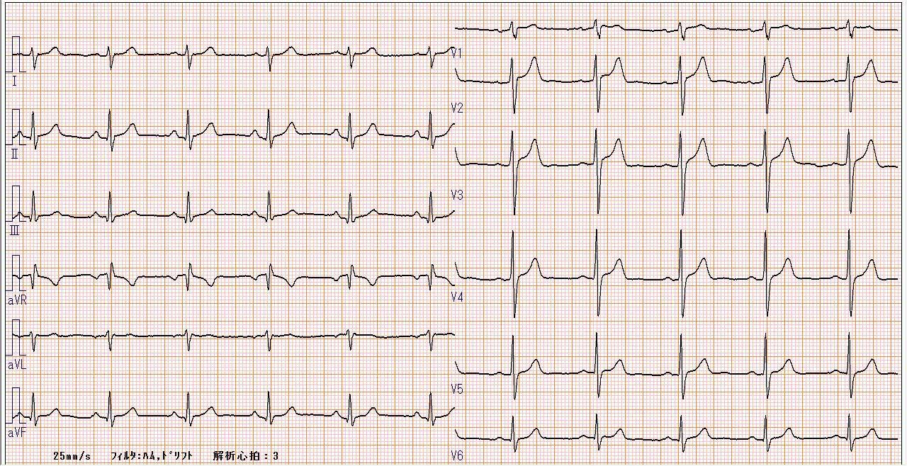 心電図２.jpg