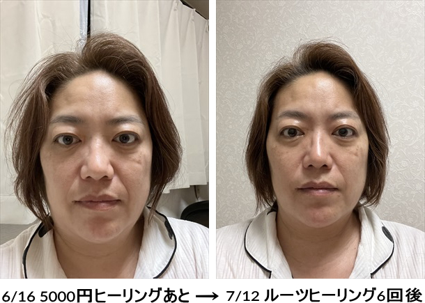 6回ルーツヒーリング後.jpg