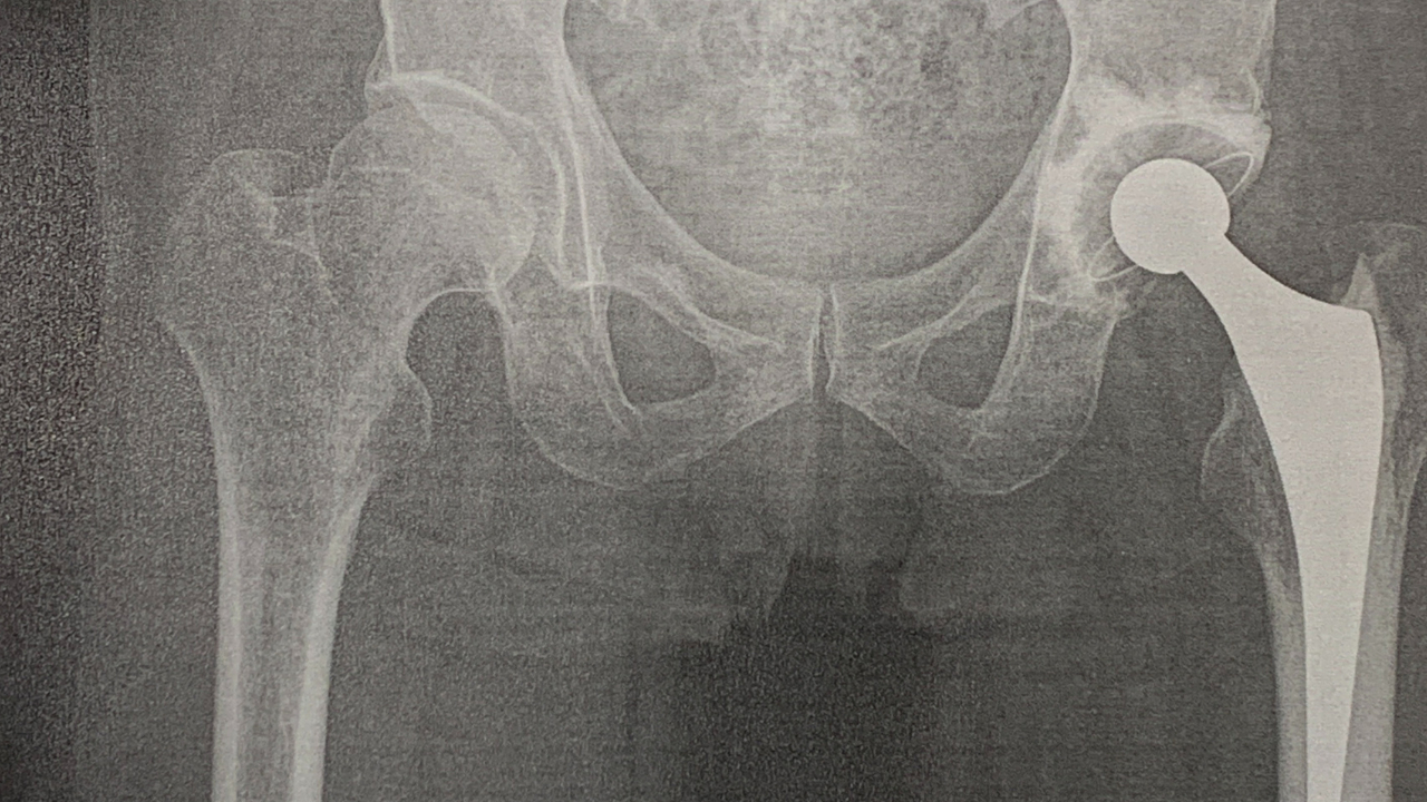 股関節　レントゲン画像.png
